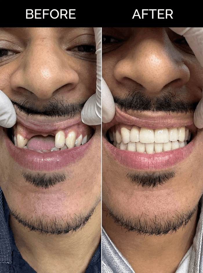 Transformation dentaire avant/après 1