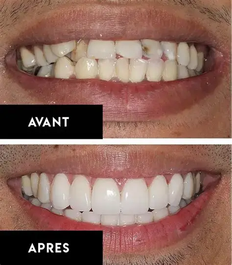 Résultat facettes dentaires