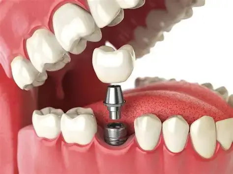Résultat implants dentaires
