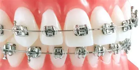 Orthodontie au Centre Dentaire Halim